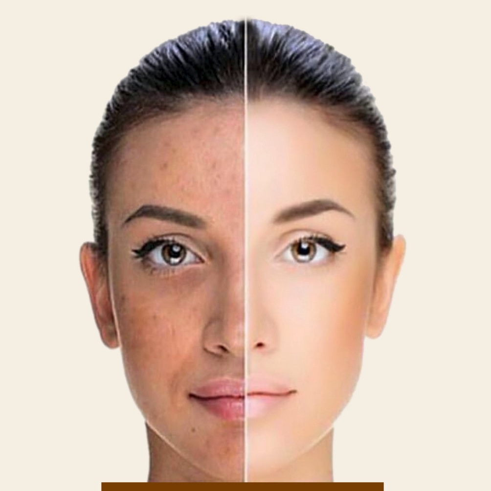 Professional acne treatment and scar reduction at D'Tanique